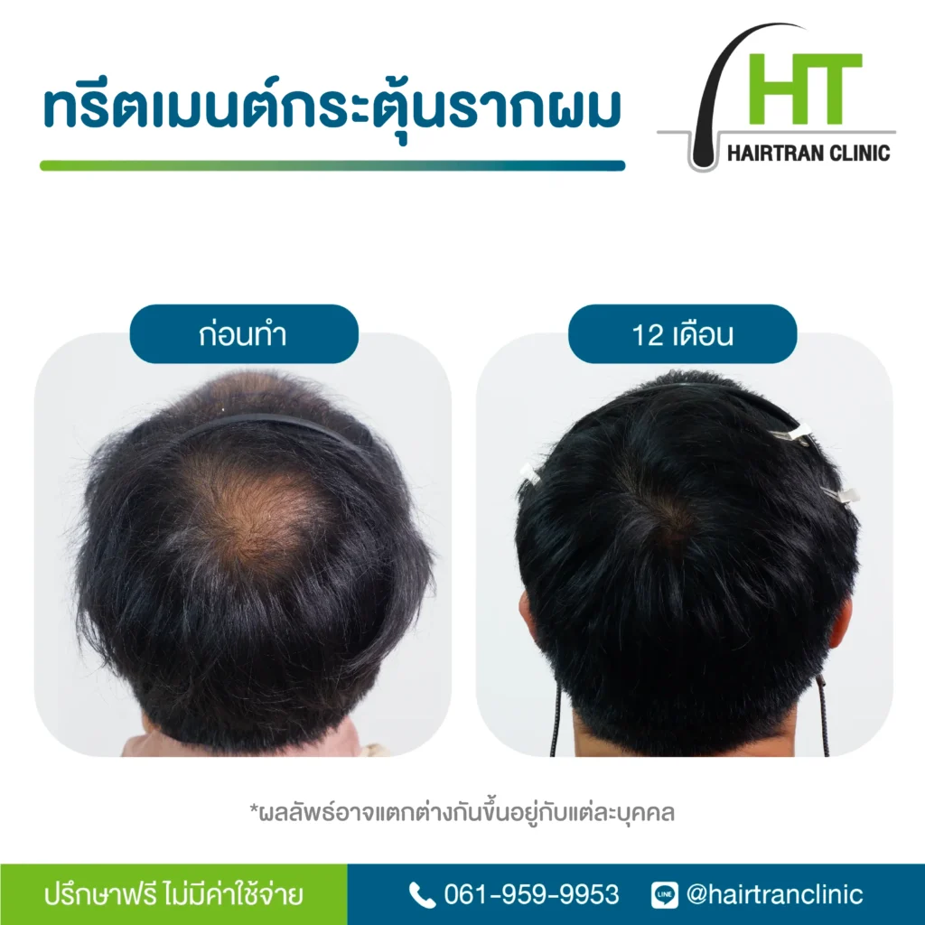 ผลลัพธ์ ฉีดเกล็ดเลือดเข้มข้น กระตุ้นรากผม 5 เดือน