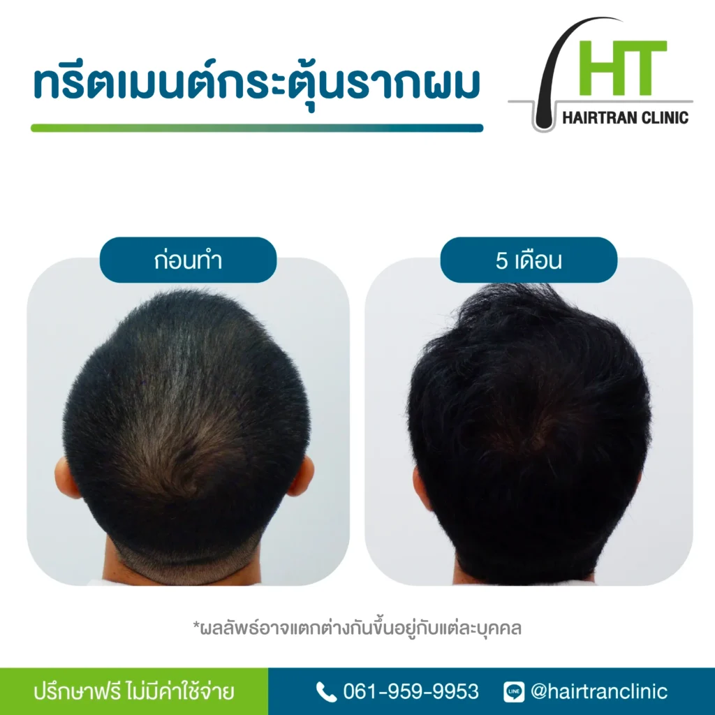 ทรีตเมนต์กระตุ้นรากผม Hairtran Clinic