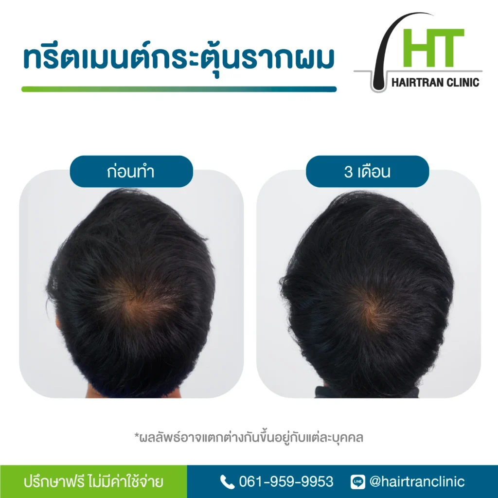 ผลลัพธ์ ฉีดเกล็ดเลือดเข้มข้น กระตุ้นรากผม 3 เดือน