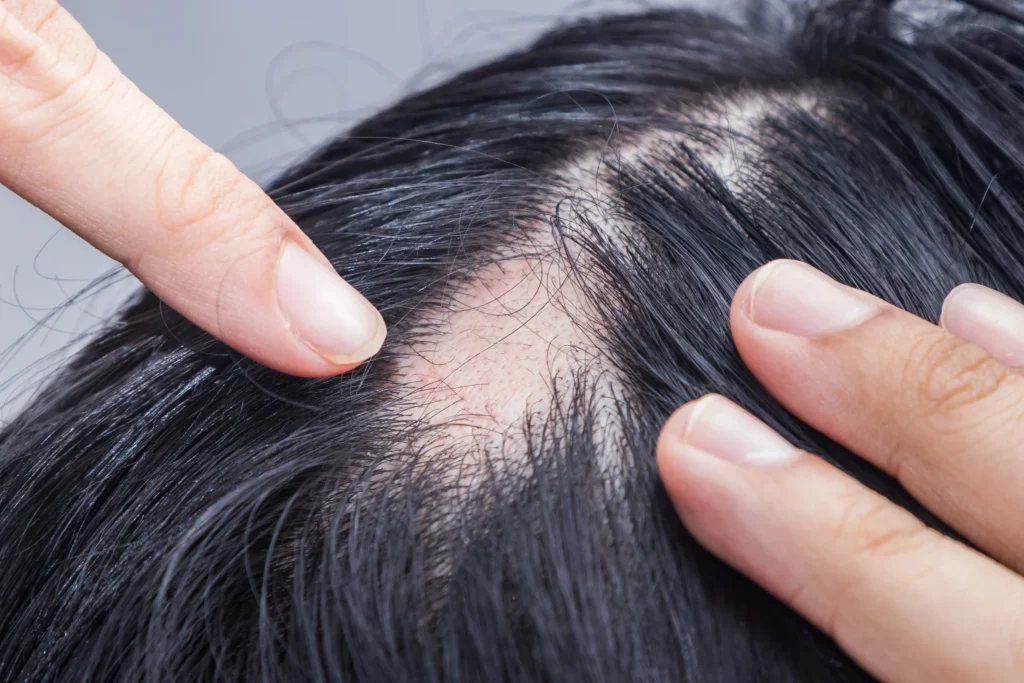 โรคภูมิแพ้รากผมตัวเอง (Alopecia Areata)
