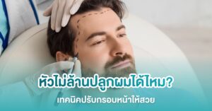 หัวไม่ล้านปลูกผมได้ไหม