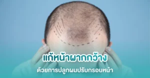 ปลูกผมแก้หน้าผากกว้าง